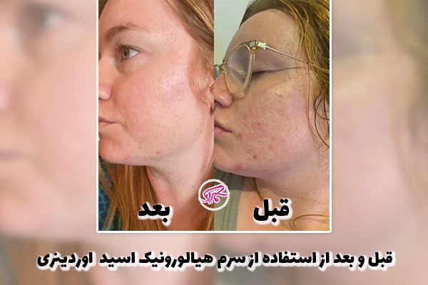 عکس قبل و بعد از استفاده از سرم هیالورونیک اسید اوردینری
