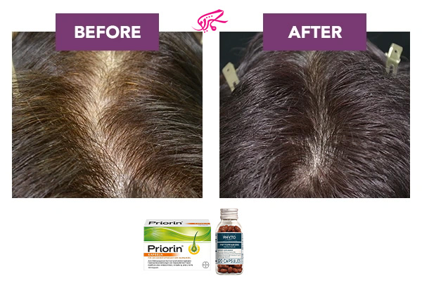 مقایسه تاثیر قرص فیتو یا پریورین بر ضخامت و کیفیت مو